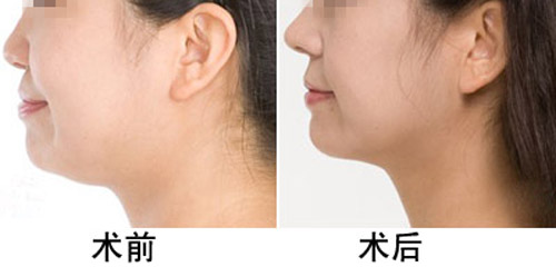 打<a href=http://www.sbs17.com/listinfo-631-0.html target=_blank class=infotextkey>瘦臉</a><a href=http://www.sbs17.com/listinfo-614-0.html target=_blank class=infotextkey>除皺</a>能吃辣嗎
