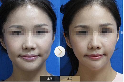 打完<a href=http://www.sbs17.com/listinfo-631-0.html target=_blank class=infotextkey>瘦臉</a><a href=http://www.sbs17.com/listinfo-614-0.html target=_blank class=infotextkey>除皺</a>影響懷孕嗎