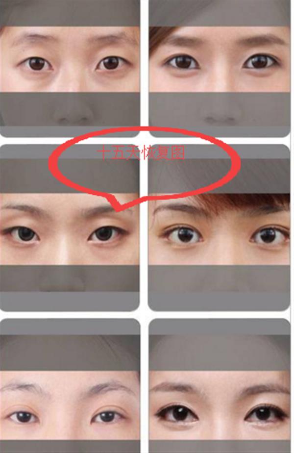 全切<a href=http://www.sbs17.com/listinfo-711-0.html target=_blank class=infotextkey>開眼角</a>15天恢復(fù)圖