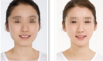 做<a href=http://www.sbs17.com/listinfo-629-0.html target=_blank class=infotextkey>下頜角</a>整形要費(fèi)用