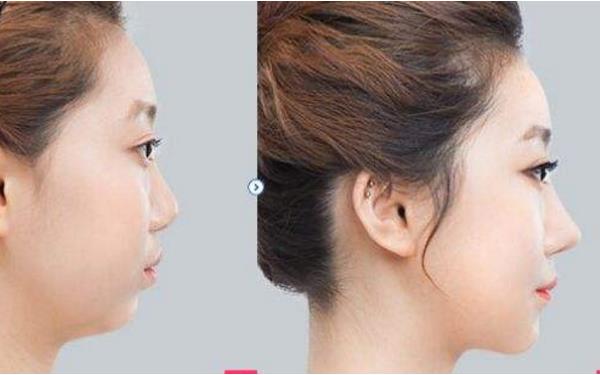 福州<a href=http://www.sbs17.com/listinfo-737-0.html target=_blank class=infotextkey>隆鼻</a>價格