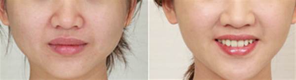 人很<a href=http://www.sbs17.com/listinfo-631-0.html target=_blank class=infotextkey>瘦臉</a>很胖怎么辦