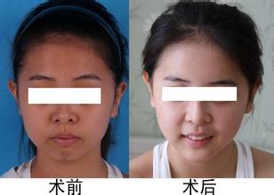 光子<a href=http://www.sbs17.com/listinfo-770-0.html target=_blank class=infotextkey>嫩膚</a>后的注意事項