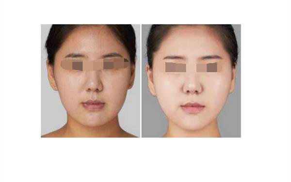 廣州彩光<a href=http://www.sbs17.com/listinfo-763-0.html target=_blank class=infotextkey><a href=http://www.sbs17.com/listinfo-770-0.html target=_blank class=infotextkey>嫩膚</a>美白</a>后的護(hù)理要注意什么