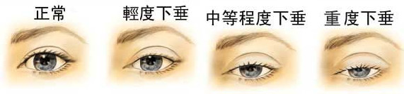 上臉下垂矯正的效果怎么樣？