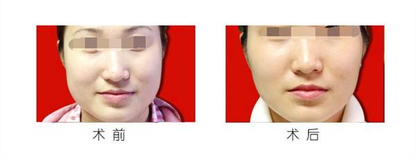 廣州<a href=http://www.sbs17.com/listinfo-629-0.html target=_blank class=infotextkey>下頜角</a>整形的術(shù)前如何準(zhǔn)備