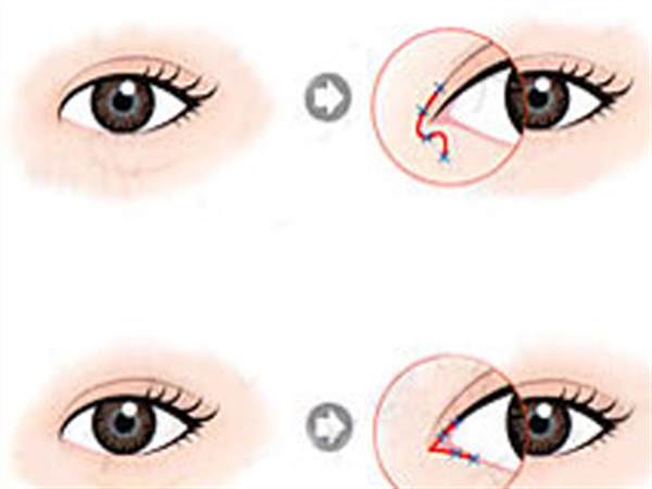 <a href=http://www.sbs17.com/listinfo-711-0.html target=_blank class=infotextkey>開眼角</a>會變成<a href=http://www.sbs17.com/listinfo-724-0.html target=_blank class=infotextkey>雙眼皮</a>嗎