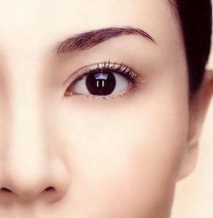 三角眼整形前后對比真人案例圖？