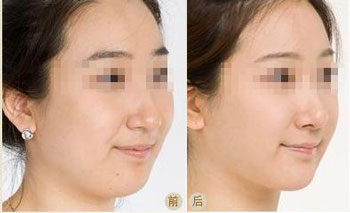 <a href=http://www.sbs17.com/listinfo-631-0.html target=_blank class=infotextkey>瘦臉</a><a href=http://www.sbs17.com/listinfo-614-0.html target=_blank class=infotextkey>除皺</a>效果較好的時間