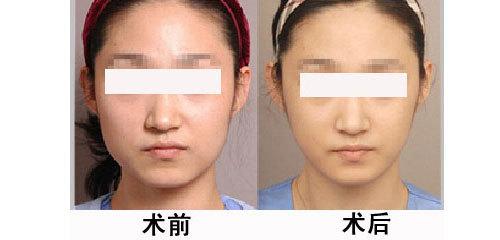 月經(jīng)期打<a href=http://www.sbs17.com/listinfo-631-0.html target=_blank class=infotextkey>瘦臉</a><a href=http://www.sbs17.com/listinfo-614-0.html target=_blank class=infotextkey>除皺</a>有什么危害