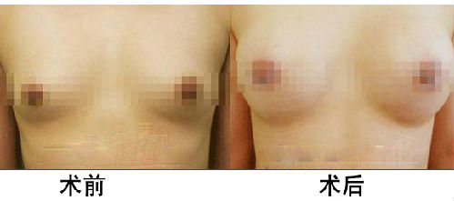 長沙假體<a href=http://www.sbs17.com/listinfo-618-0.html target=_blank class=infotextkey>隆胸</a>價格