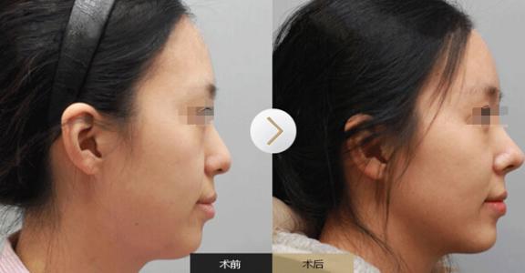 透明質(zhì)酸的<a href=http://www.sbs17.com/listinfo-737-0.html target=_blank class=infotextkey>隆鼻</a>效果是否自然