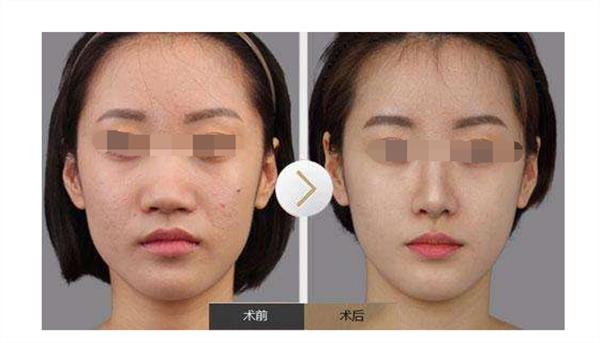 <a href=http://www.sbs17.com/listinfo-754-0.html target=_blank class=infotextkey>鼻翼</a>縮小術(shù)后護(hù)理措施有哪些