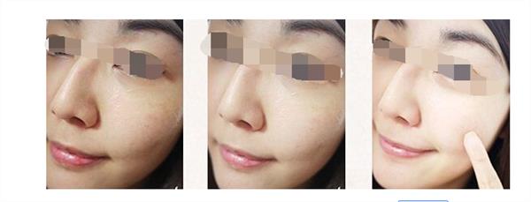 彩光<a href=http://www.sbs17.com/listinfo-770-0.html target=_blank class=infotextkey>嫩膚</a>術(shù)后需要注意哪些事項(xiàng)呢
