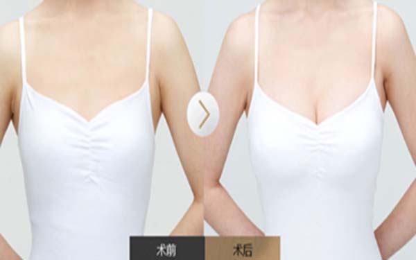 妙桃假體<a href=http://www.sbs17.com/listinfo-618-0.html target=_blank class=infotextkey>隆胸</a>術(shù)后多久自然
