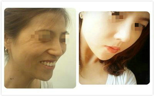 做透明質(zhì)酸<a href=http://www.sbs17.com/listinfo-737-0.html target=_blank class=infotextkey>隆鼻</a>注意事項？