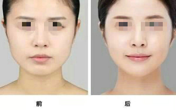 注射<a href=http://www.sbs17.com/listinfo-737-0.html target=_blank class=infotextkey>隆鼻</a>有什么壞處？