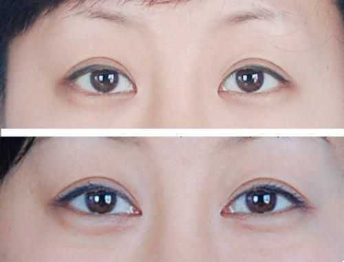 開(kāi)個(gè)眼角需要多少錢