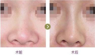 <a href=http://www.sbs17.com/listinfo-754-0.html target=_blank class=infotextkey>鼻翼</a>縮小手術(shù)做了后悔怎么辦