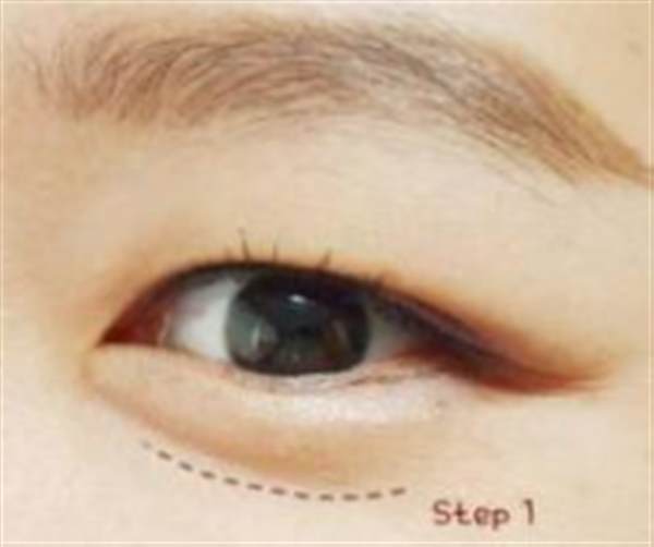 透明質(zhì)酸注射<a href=http://www.sbs17.com/listinfo-722-0.html target=_blank class=infotextkey>臥蠶</a>多少錢