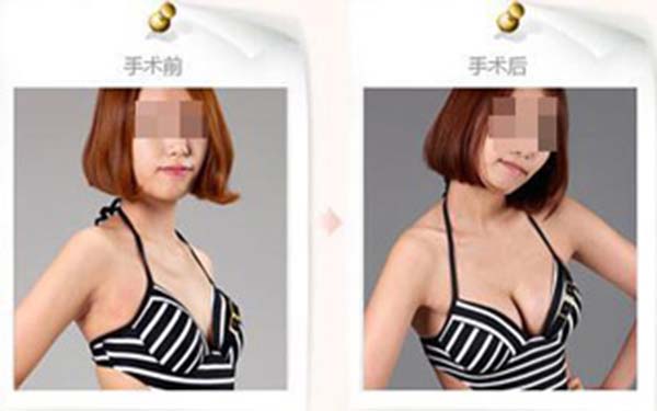 妙桃假體<a href=http://www.sbs17.com/listinfo-618-0.html target=_blank class=infotextkey>隆胸</a>術(shù)后須知
