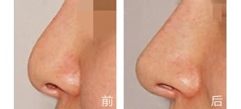如何通過手術(shù)縮小<a href=http://www.sbs17.com/listinfo-754-0.html target=_blank class=infotextkey>鼻翼</a>