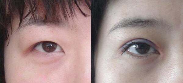 <a href=http://www.sbs17.com/listinfo-711-0.html target=_blank class=infotextkey>開眼角</a>圖片前后對比