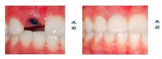 補(bǔ)牙和<a href=http://www.sbs17.com/listinfo-829-0.html target=_blank class=infotextkey>烤瓷牙</a>的區(qū)別