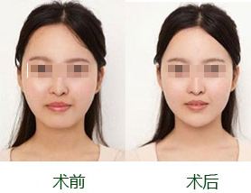 自體脂肪豐下巴特點(diǎn)有哪些