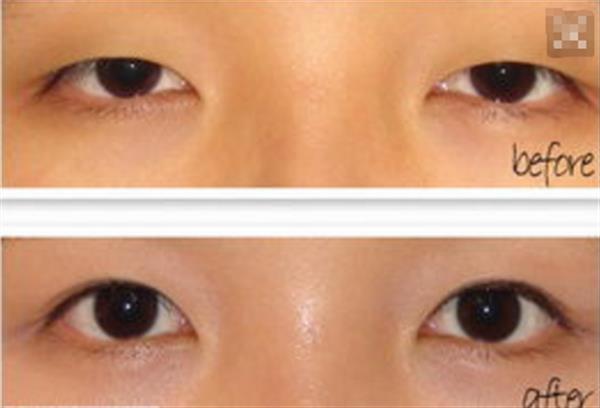 開內(nèi)眼角多少錢