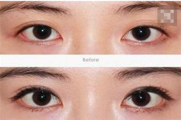 開(kāi)內(nèi)眼角一定會(huì)留疤嗎