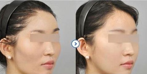 磨骨和削骨的區(qū)別