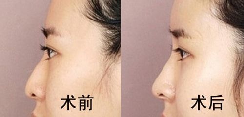 假體<a href=http://www.sbs17.com/listinfo-737-0.html target=_blank class=infotextkey>隆鼻</a>價(jià)位