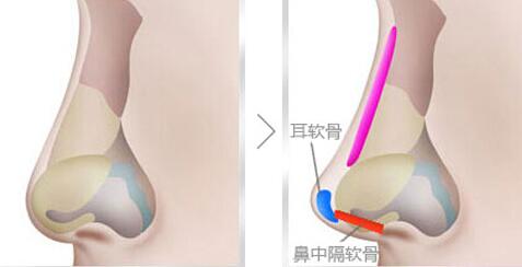 自體軟骨<a href=http://www.sbs17.com/listinfo-737-0.html target=_blank class=infotextkey>隆鼻</a>的手術(shù)效果好不好呢