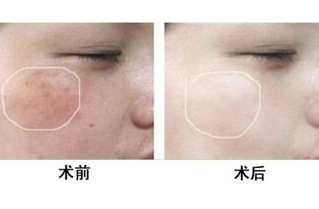 激光<a href=http://www.sbs17.com/listinfo-795-0.html target=_blank class=infotextkey>祛斑</a>幾天結痂脫落