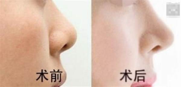 膨體<a href=http://www.sbs17.com/listinfo-737-0.html target=_blank class=infotextkey>隆鼻</a>可以長期嗎
