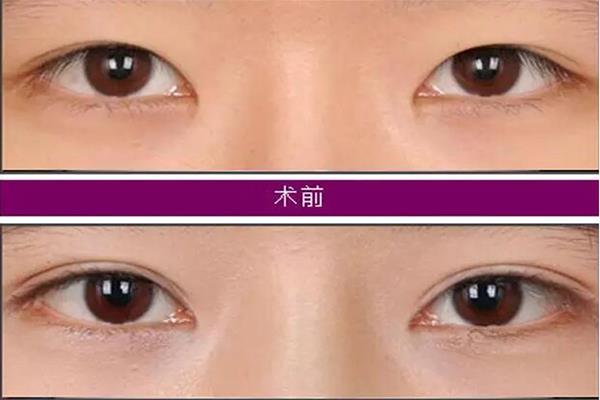 開(kāi)內(nèi)眼角圖片對(duì)比照片