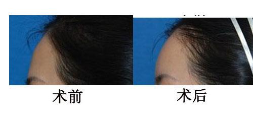 上海自體脂肪<a href=http://www.sbs17.com/listinfo-643-0.html target=_blank class=infotextkey>豐額頭</a>大概需要多少錢