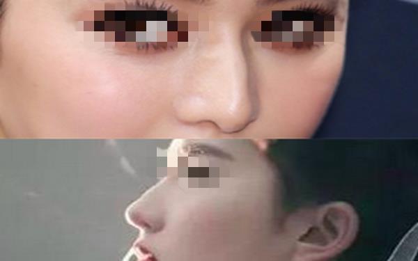 韓式<a href=http://www.sbs17.com/listinfo-737-0.html target=_blank class=infotextkey>隆鼻</a>一般多少錢