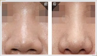 透明質(zhì)酸<a href=http://www.sbs17.com/listinfo-737-0.html target=_blank class=infotextkey>隆鼻</a>變寬效果圖