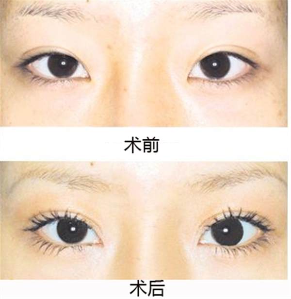 北京開內(nèi)眼角哪里比較好