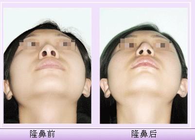 假體<a href=http://www.sbs17.com/listinfo-737-0.html target=_blank class=infotextkey>隆鼻</a>前期要準(zhǔn)備些什么
