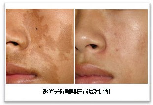 氫醌霜<a href=http://www.sbs17.com/listinfo-795-0.html target=_blank class=infotextkey>祛斑</a>的危害