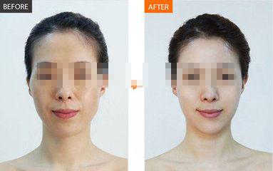 打水光<a href=http://www.sbs17.com/listinfo-770-0.html target=_blank class=infotextkey>嫩膚</a>的危害后遺癥
