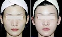 臉部脂肪填充消腫過程
