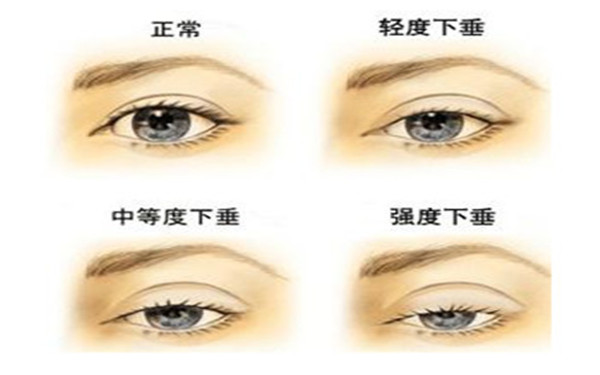 上瞼下垂的危害