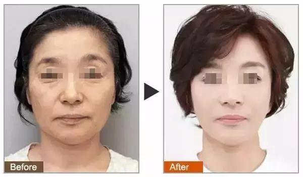 脂肪填充多久可以化妝