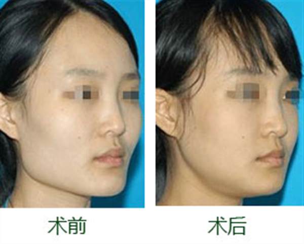 下頜骨手術(shù)的風(fēng)險(xiǎn)
