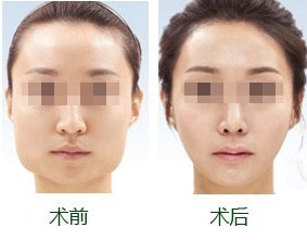 下頜骨手術(shù)后遺癥