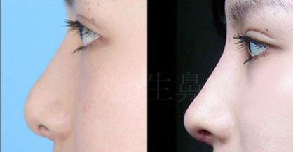 西安<a href=http://www.sbs17.com/listinfo-737-0.html target=_blank class=infotextkey>隆鼻</a>價位
